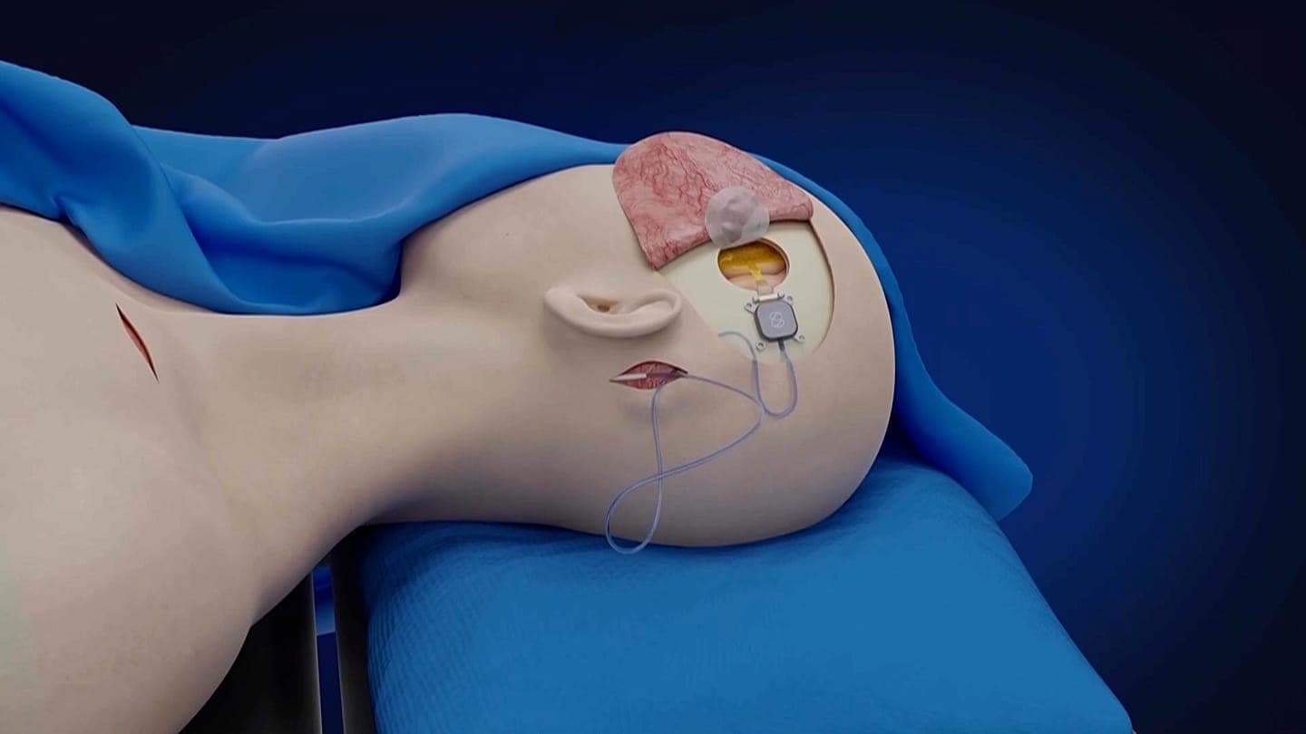 54 impianti cerebrali in Cina, zero in Italia: il fallimento europeo sulle BCI